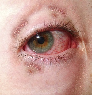 herpetic-eye-disease