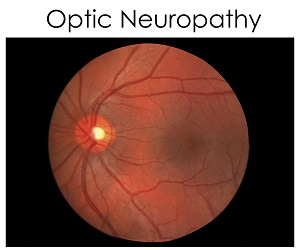 optic-neuropathy