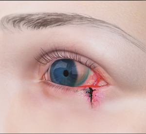 Treatment of Ocular/Orbital Trauma